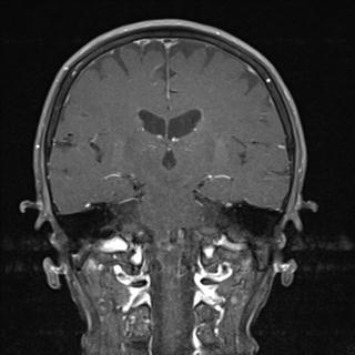 File:Base of skull chondrosarcoma (Radiopaedia 30410-31070 G 13).jpg