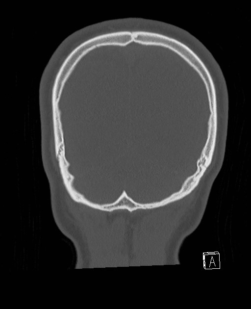 Base of skull fracture with bilateral Le Fort fractures (Radiopaedia 47094-51638 Coronal bone window 15).jpg