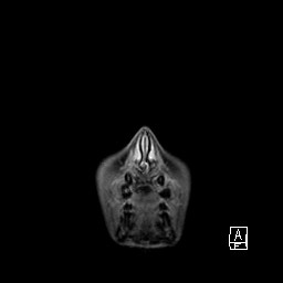 Base of skull rhabdomyosarcoma (Radiopaedia 32196-33142 I 7).jpg