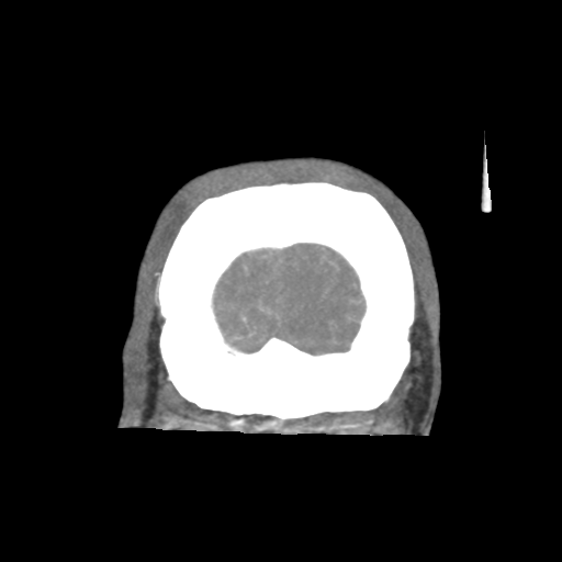 Basilar and bilateral vertebral artery occlusion (Radiopaedia 45592-49723 B 91).png