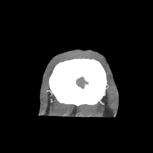 Basilar and bilateral vertebral artery occlusion (Radiopaedia 45592-49723 B 97).png
