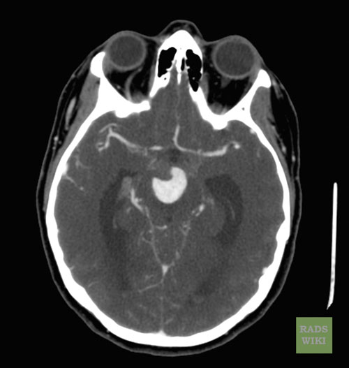 File:Basilar artery aneurysm (Radiopaedia 11533-11896 Axial 2).jpg