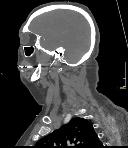 Basilar artery aneurysm (Radiopaedia 56261-62932 C 4).jpg