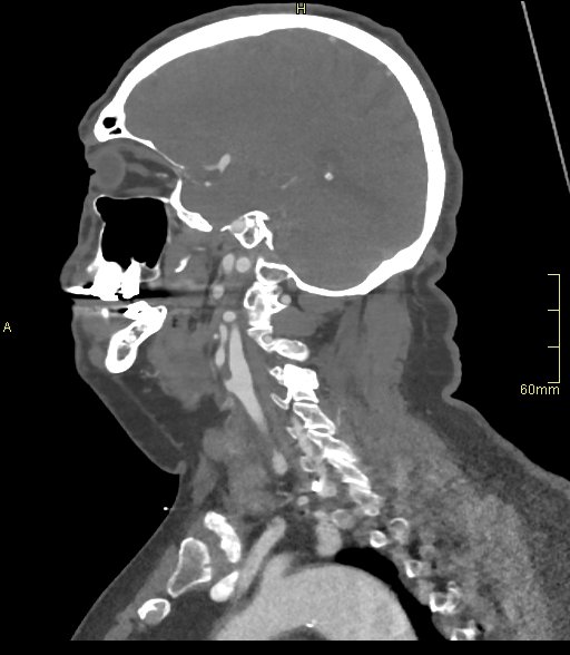 Basilar artery aneurysm (Radiopaedia 56261-62932 C 47).jpg