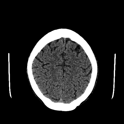 File:Basilar artery perforator aneurysm (Radiopaedia 82455-96597 Axial non-contrast 27).jpg