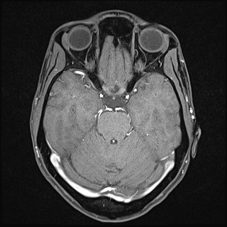 Basilar artery perforator aneurysm (Radiopaedia 82455-97733 Axial T1 fat sat 56).jpg