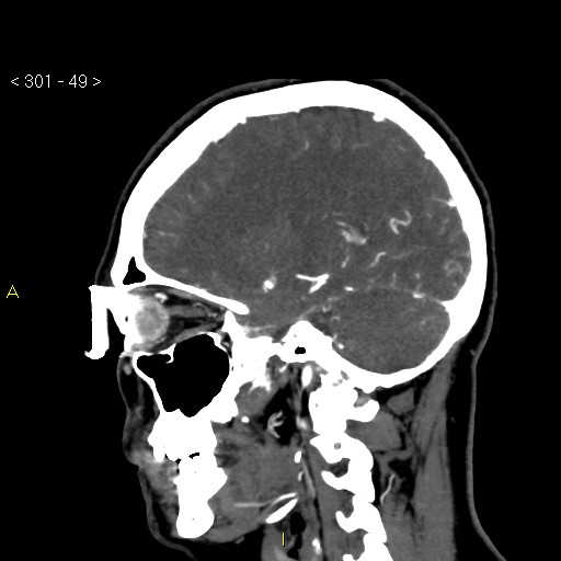 Basilar artery thrombosis (Radiopaedia 16260-15944 C 43).jpg