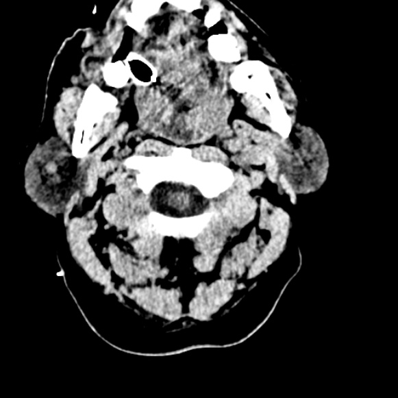 Basilar artery thrombosis (Radiopaedia 53351-59333 Axial non-contrast 7).jpg