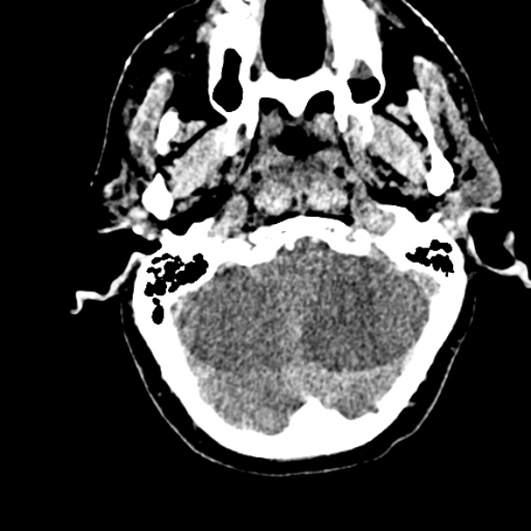 Basilar artery thrombosis (Radiopaedia 53351-59352 Axial non-contrast 27).jpg