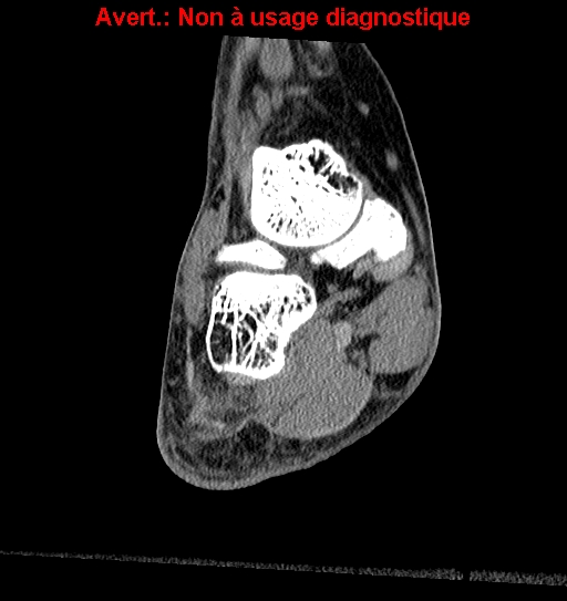 Baxter neuropathy (Radiopaedia 25988-26125 Coronal non-contrast 5).jpg