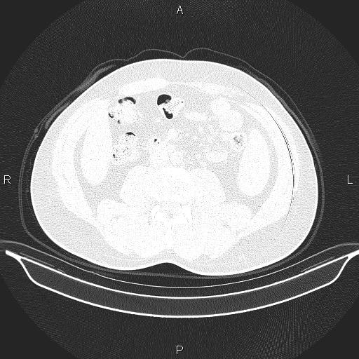 Beam hardening and ring artifacts (Radiopaedia 85323-100915 Axial lung window 95).jpg