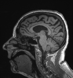 Behavioral variant frontotemporal dementia and late onset schizophrenia (Radiopaedia 52197-58083 Sagittal T1 43).png