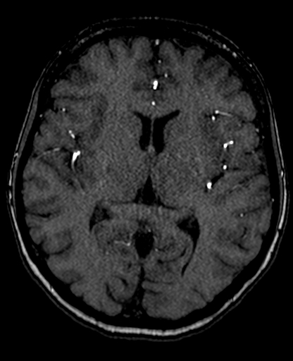 Berry aneurysm of the terminal internal carotid artery (Radiopaedia 88286-104918 Axial TOF 133).jpg