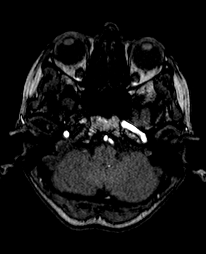 Berry aneurysm of the terminal internal carotid artery (Radiopaedia 88286-104918 Axial TOF 63).jpg