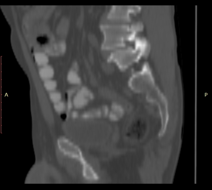 Bertolotti syndrome (Radiopaedia 58974-66235 Sagittal bone window 37).jpg