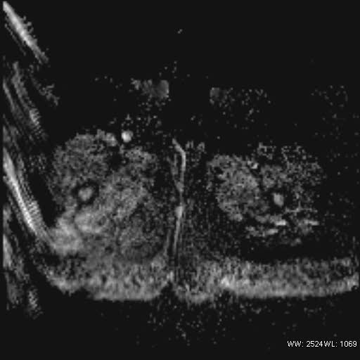 File:Bicornuate uterus- on MRI (Radiopaedia 49206-54297 Axial ADC 28).jpg