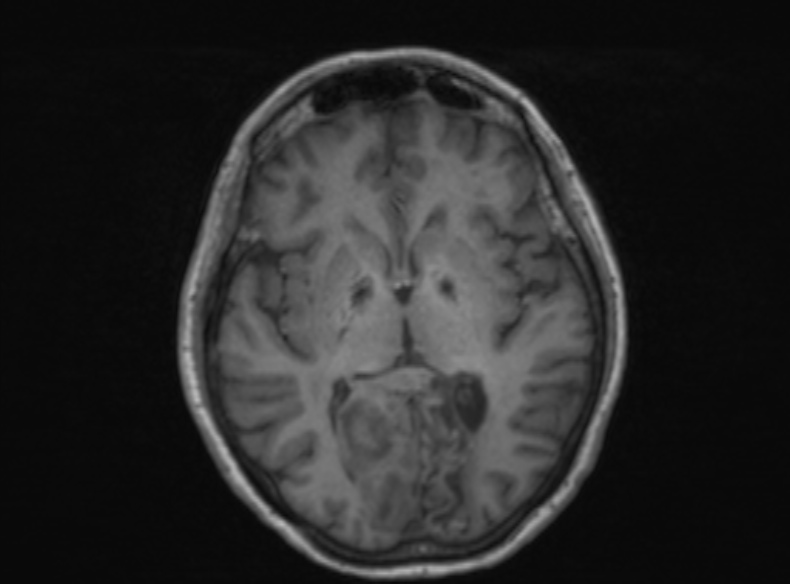 Bilateral PCA territory infarction - different ages (Radiopaedia 46200-51784 Axial T1 237).jpg