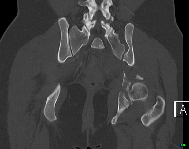 File:Bilateral acetabular fractures (Radiopaedia 79272-92308 Coronal bone window 29).jpg