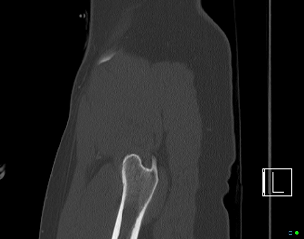 File:Bilateral acetabular fractures (Radiopaedia 79272-92308 Sagittal bone window 8).jpg