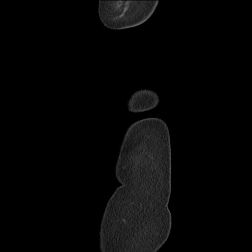 Bilateral adrenal granulocytic sarcomas (chloromas) (Radiopaedia 78375-91007 C 138).jpg
