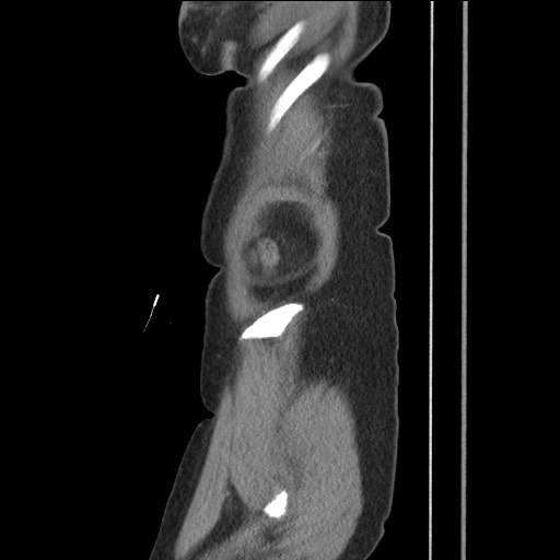 Bilateral adrenal granulocytic sarcomas (chloromas) (Radiopaedia 78375-91007 C 22).jpg