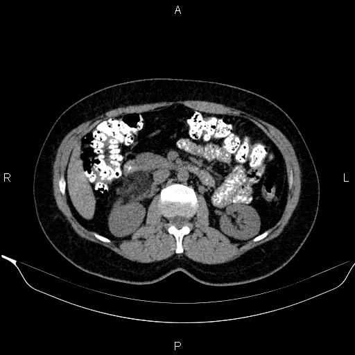 Bilateral adrenal myelolipoma (Radiopaedia 63058-71535 Axial non-contrast 72).jpg