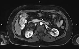 Bilateral adrenal myelolipoma (Radiopaedia 63058-71537 Axial T1 C+ fat sat 47).jpg