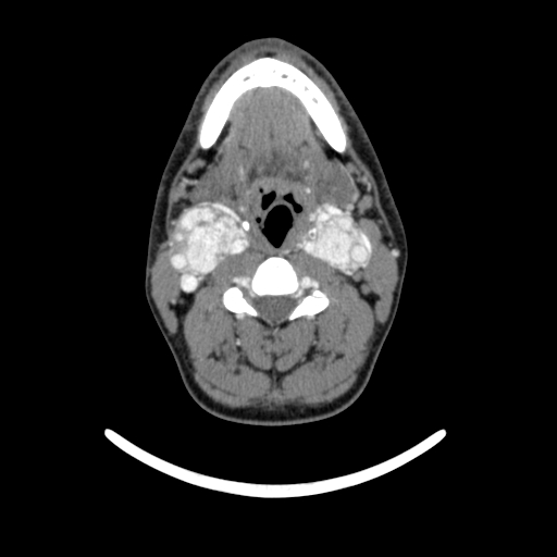 Bilateral carotid body tumors (Radiopaedia 52899-58827 A 12).jpg