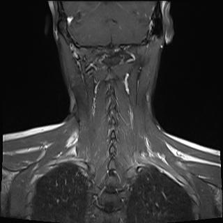 File:Bilateral carotid body tumors and right jugular paraganglioma (Radiopaedia 20024-20060 None 17).jpg