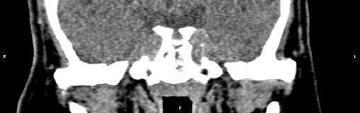 File:Bilateral enlargement of lacrimal glands - sarcoidosis (Radiopaedia 62627-70921 Coronal non-contrast 28).jpg