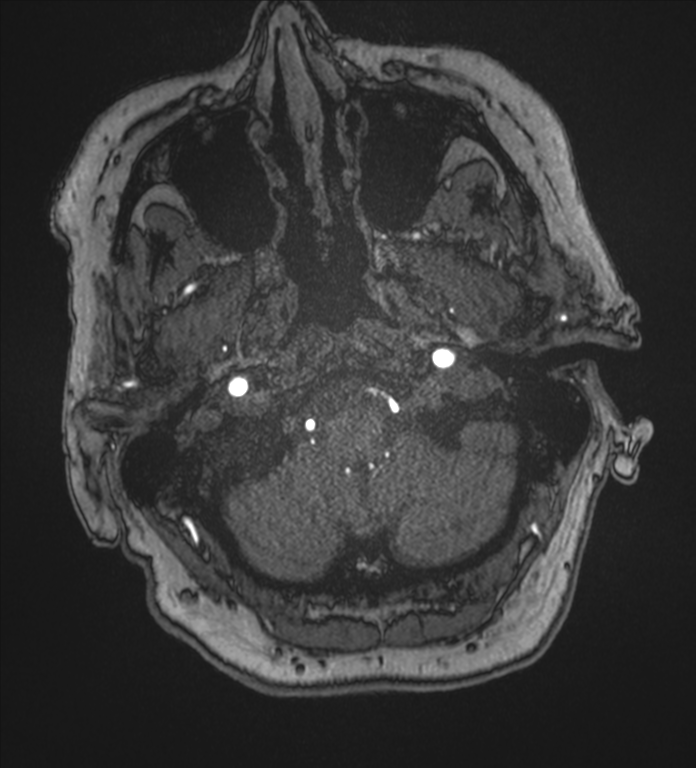 Bilateral fetal posterior communicating arteries (Radiopaedia 41286-44102 Axial MRA 7).png
