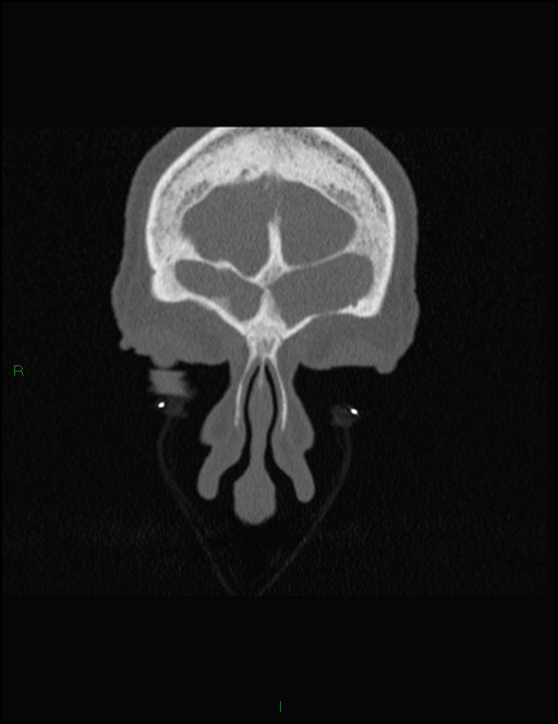 Bilateral frontal mucoceles (Radiopaedia 82352-96454 Coronal 55).jpg