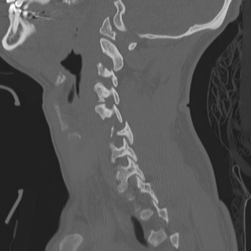 Bilateral locked facets (Radiopaedia 33850-35016 Sagittal bone window 13).png