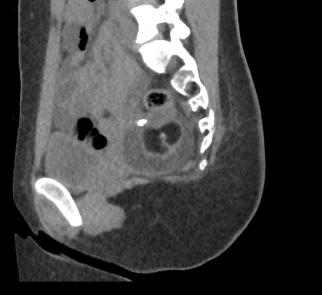Bilateral mature cystic ovarian teratoma (Radiopaedia 88821-105592 D 41).jpg