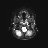 File:Bilateral mesial temporal polymicrogyria (Radiopaedia 76456-88181 Axial DWI 2).jpg