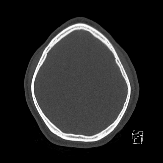 File:Bilateral occipital condyle fracture (type 2) (Radiopaedia 87675-104089 Axial bone window 105).jpg