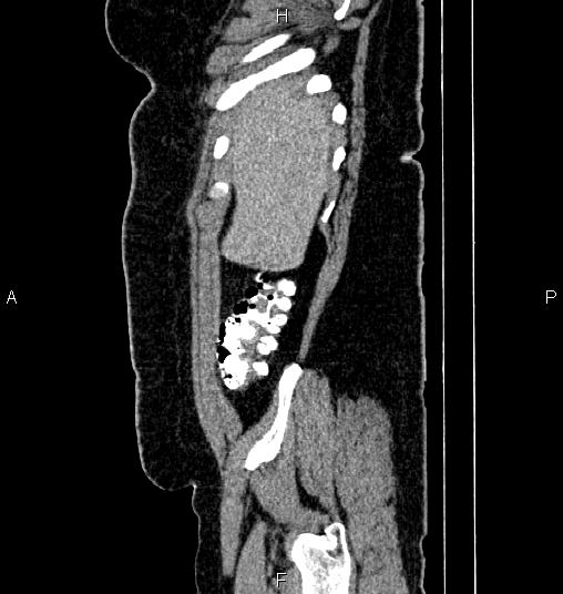 Bilateral ovarian dermoid cysts (Radiopaedia 85785-101603 D 5).jpg