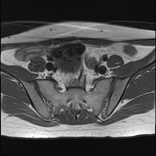 File:Bilateral ovarian endometriomas (Radiopaedia 87085-103347 Axial T1 4).jpg