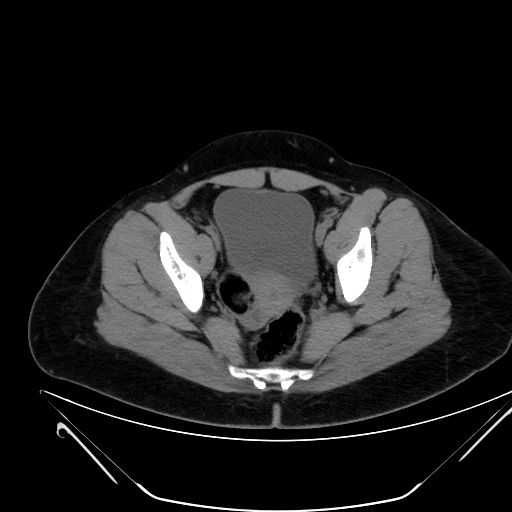 Bilateral ovarian mature cystic teratomas (Radiopaedia 79373-92457 Axial non-contrast 68).jpg