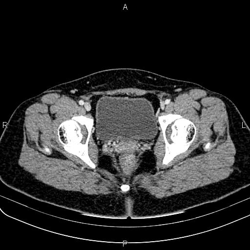Bilateral ovarian teratoma (Radiopaedia 83131-97503 Axial With contrast 66).jpg