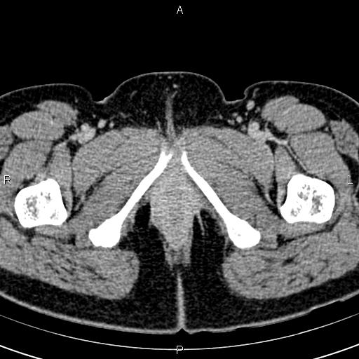 Bilateral ovarian teratoma (Radiopaedia 83131-97503 B 89).jpg