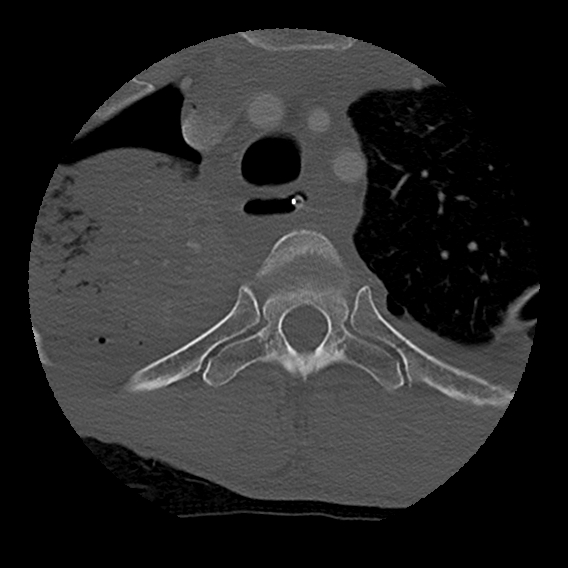 Bilateral perched facets with cord injury (Radiopaedia 45587-49713 Axial bone window 122).jpg