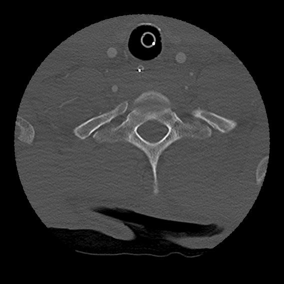 Bilateral perched facets with cord injury (Radiopaedia 45587-49713 Axial bone window 91).jpg