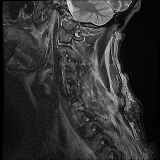 File:Bilateral perched facets with cord injury (Radiopaedia 45587-49714 Sagittal STIR 2).jpg
