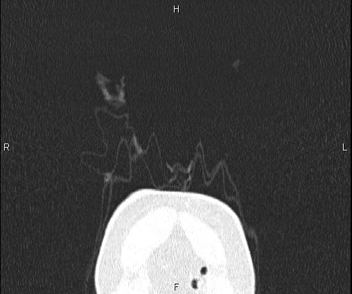 Bilateral pulmonary AVM (Radiopaedia 83134-97505 Coronal lung window 4).jpg