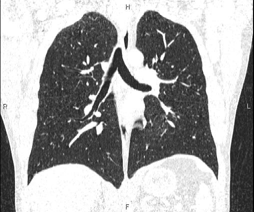 Bilateral pulmonary AVM (Radiopaedia 83134-97505 Coronal lung window 48).jpg