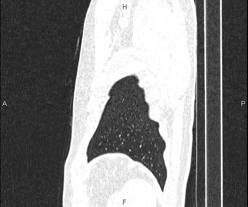 File:Bilateral pulmonary AVM (Radiopaedia 83134-97505 Sagittal lung window 102).jpg