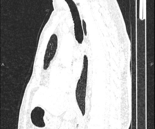 Bilateral pulmonary AVM (Radiopaedia 83134-97505 Sagittal lung window 59).jpg