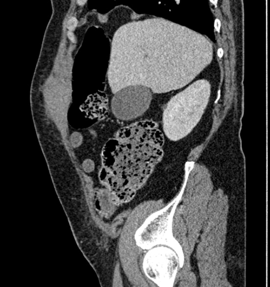 File:Bilateral rectus sheath hematomas (Radiopaedia 50778-56252 B 21).jpg