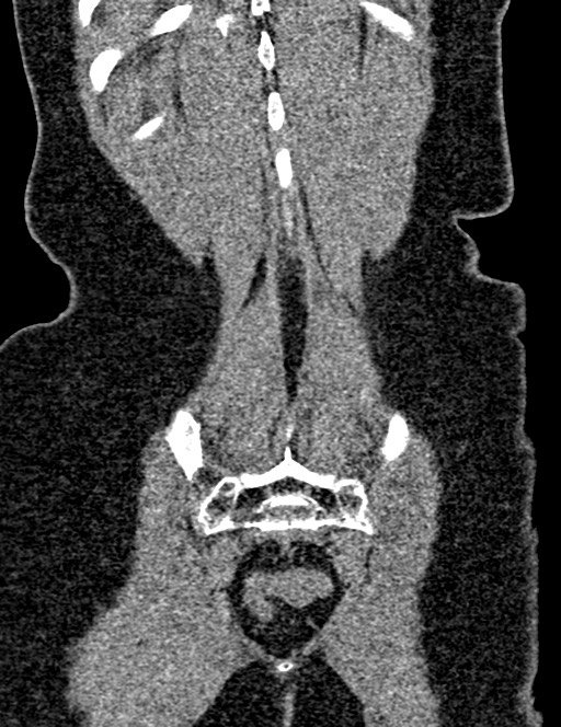 Bilateral staghorn calculi (Radiopaedia 59475-66842 Coronal non-contrast 87).jpg